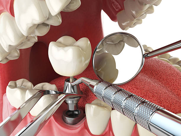 Best Emergency Root Canal Treatment in Brookings, OR